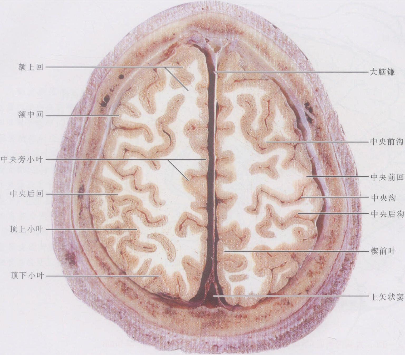 正中线处纵裂内的大脑镰cerebralfalx,分隔两侧半球,前,后端有上矢状